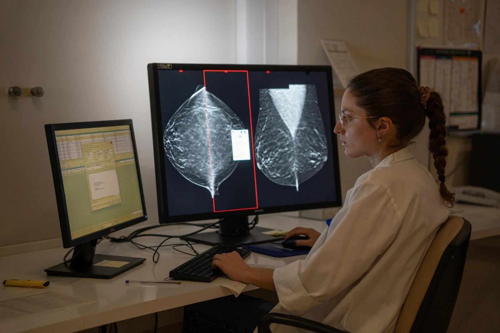 IA en la mamografía para predecir el riesgo de cáncer de mama