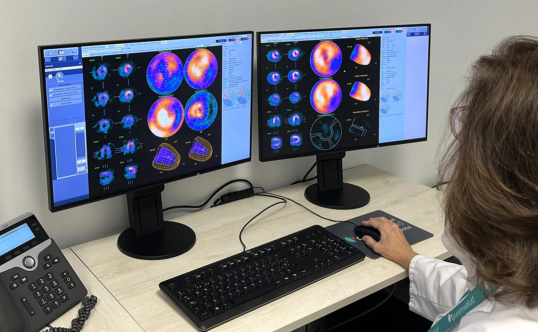 La gammagrafía cardíaca con tecnología híbrida SPECT-CT permite detectar la enfermedad coronaria antes de que aparezcan los síntomas